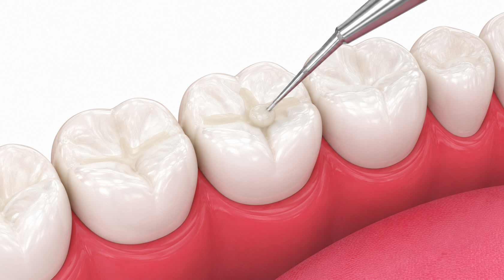 Dental Fillings in Nairobi - Professional dental care and treatment at Express Smiles Dental Suite
