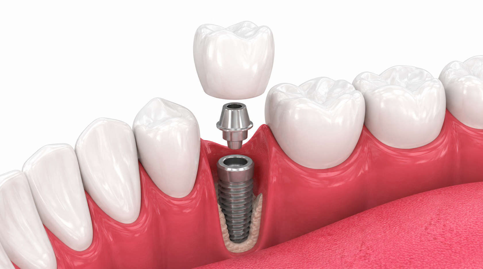 Dental Implants in Nairobi - Professional dental care and treatment at Express Smiles Dental Suite