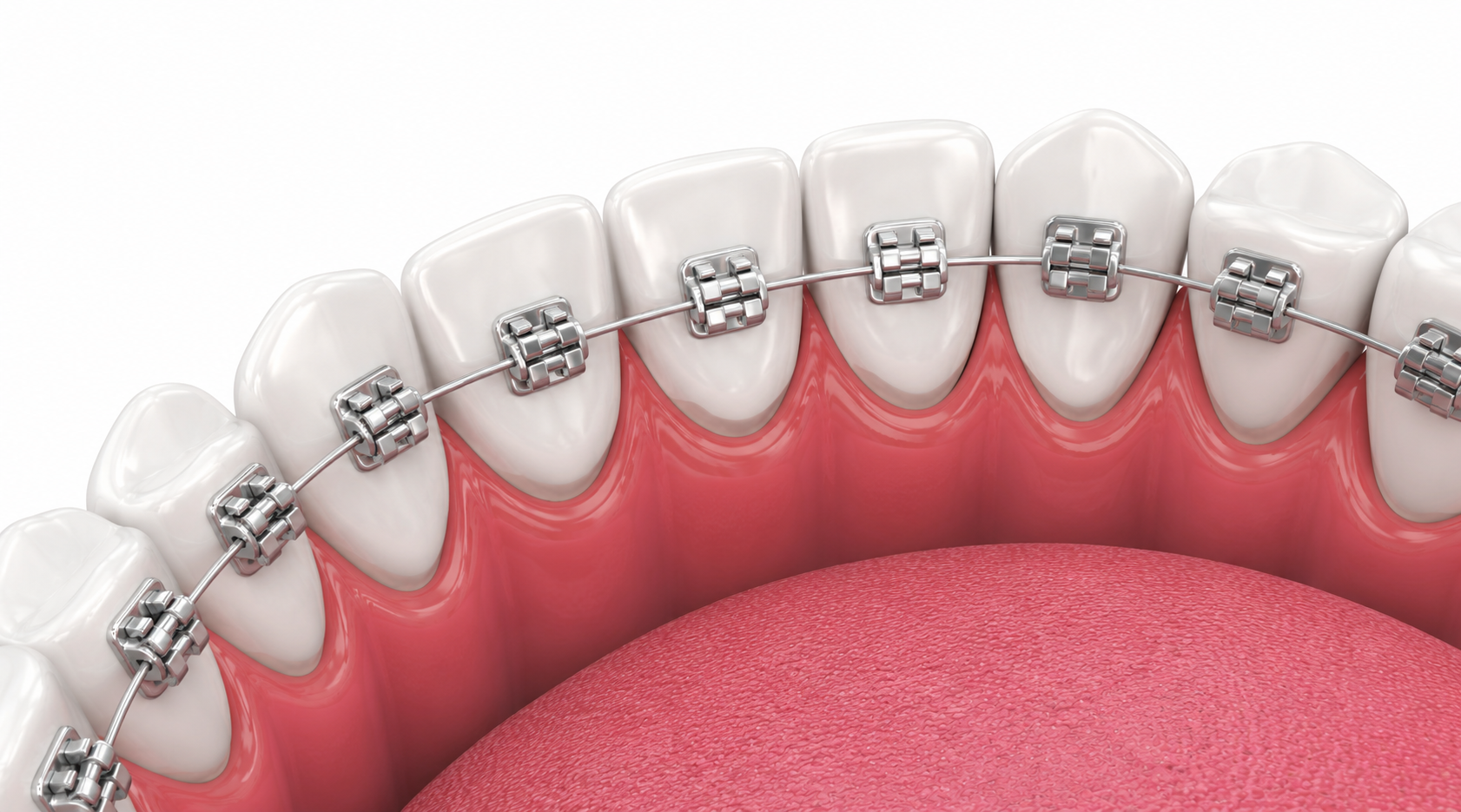 Orthodontics in Nairobi - Professional dental care and treatment at Express Smiles Dental Suite