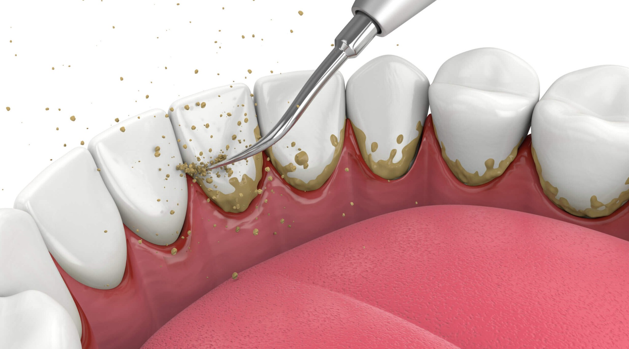 Professional Teeth Cleaning in Nairobi - Professional dental care and treatment at Express Smiles Dental Suite