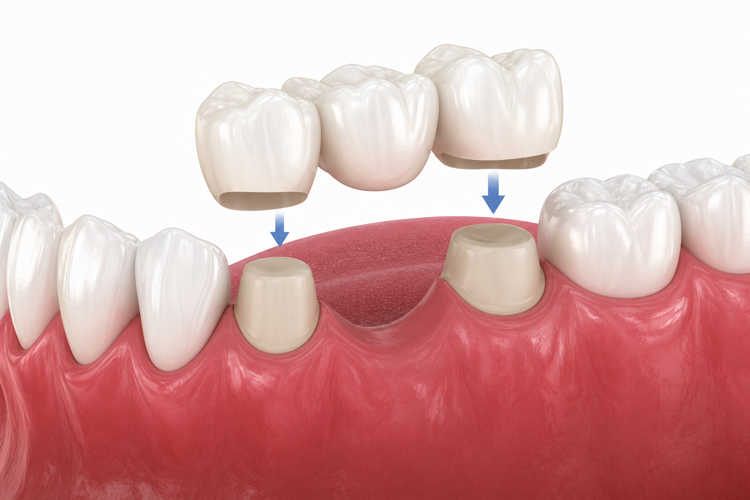 Teeth Replacement in Nairobi - Professional dental care and treatment at Express Smiles Dental Suite