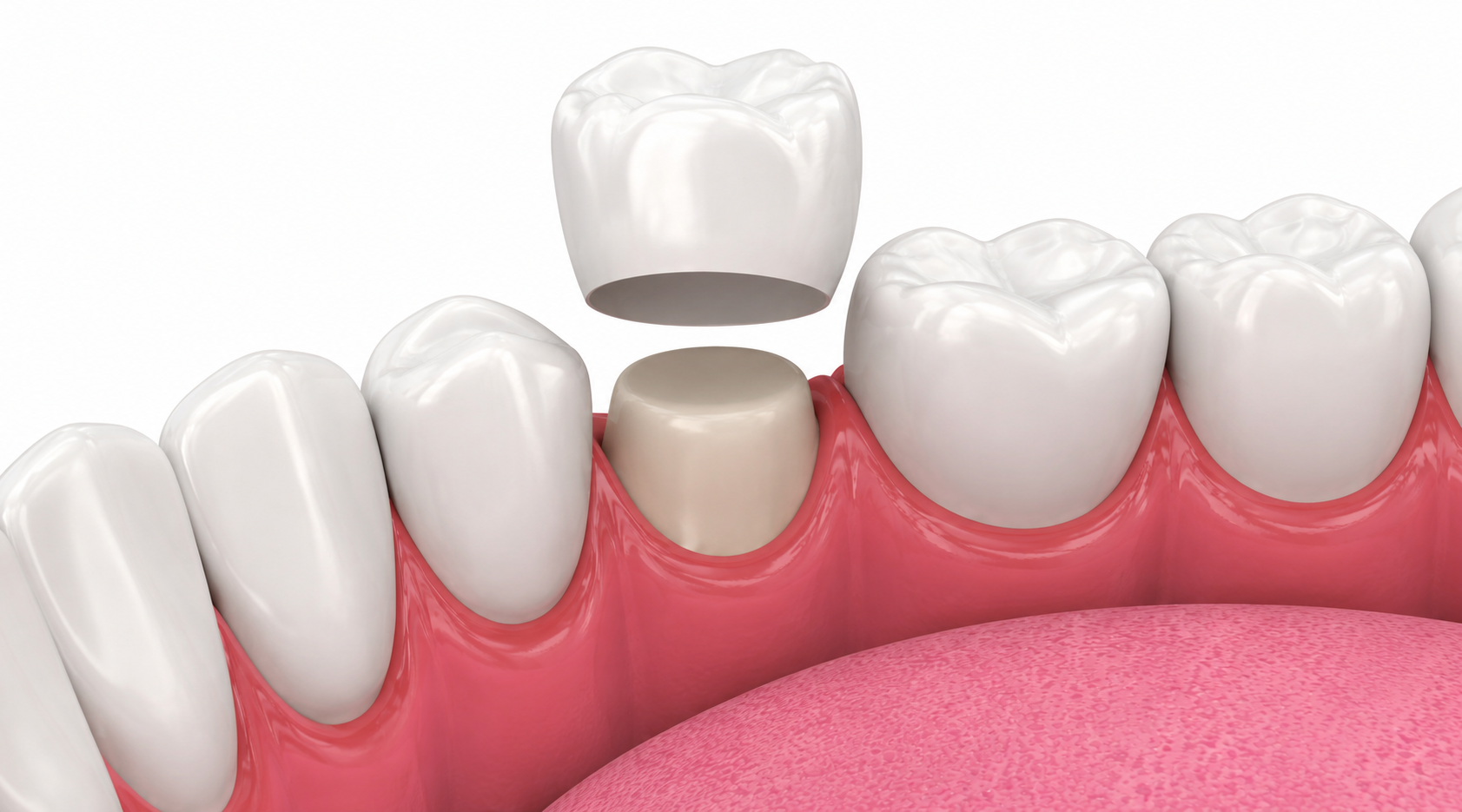 Dental Crowns in Nairobi - Professional dental care and treatment at Express Smiles Dental Suite