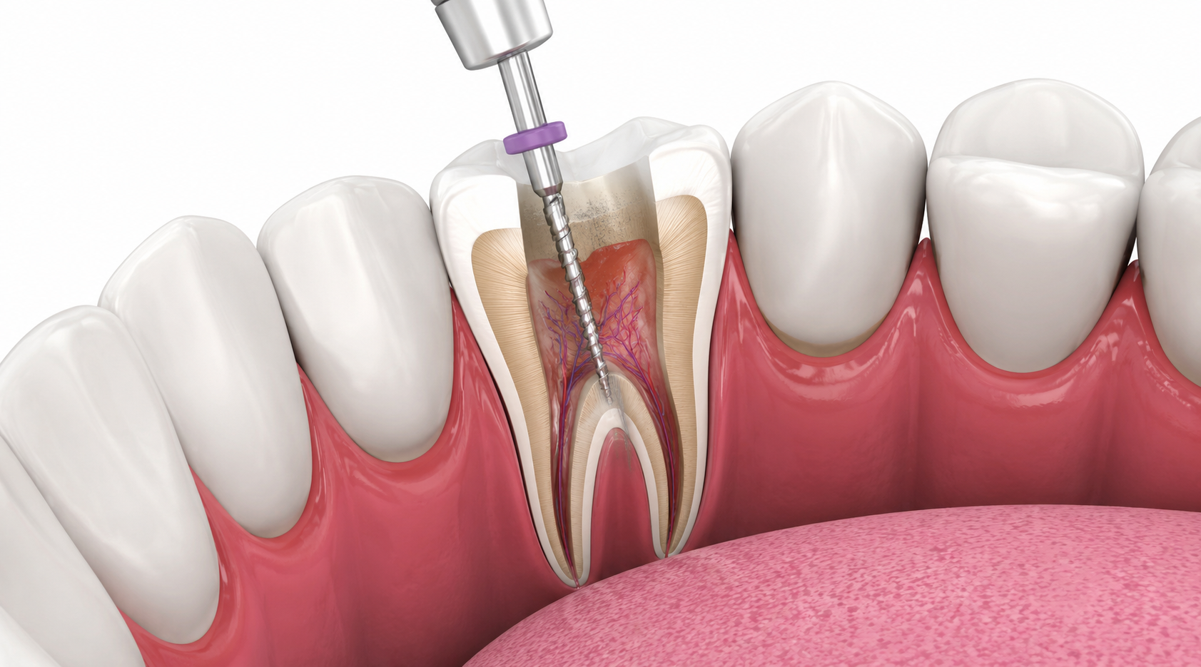 Root Canal Treatment in Nairobi - Professional dental care and treatment at Express Smiles Dental Suite