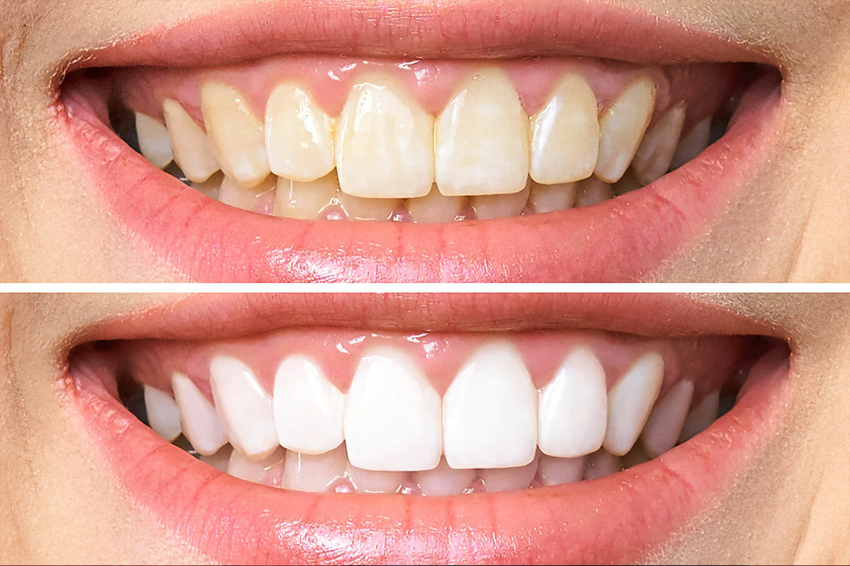 Teeth Whitening in Nairobi - Professional dental care and treatment at Express Smiles Dental Suite