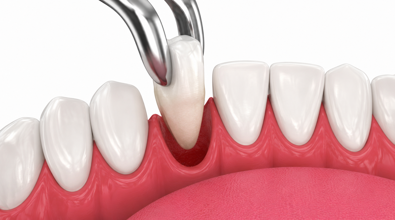 Teeth Extraction in Nairobi - Professional dental care and treatment at Express Smiles Dental Suite